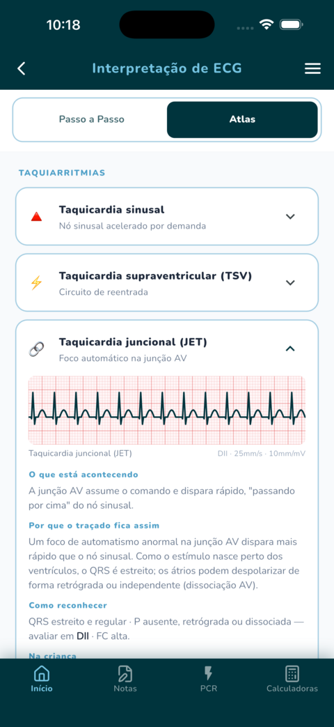 Atlas de ECG pediátrico — taquiarritmias com traçado e como reconhecer